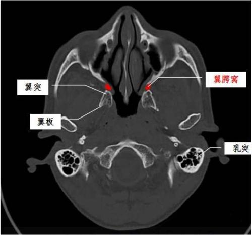 资讯文章 正文 上壁是蝶骨体,蝶骨大翼和翼突基底部 外壁开放 向前