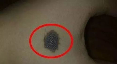 【注意区分老年疣(a)和普通色素痣】