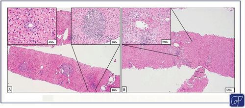 如何确定是肝脏炎症活动期