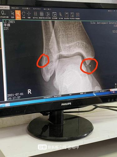 到医院拍了片子,医生说骨折了,片子显示右脚踝骨折两处.