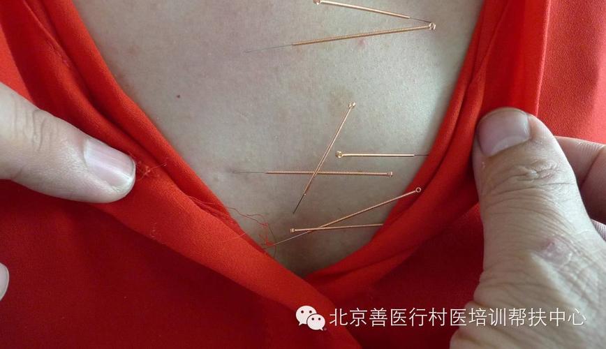 郑卫东教授全息易像针灸:组合针法