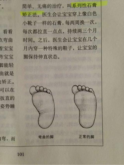 新生儿脚踝内弯