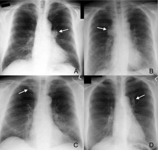 间隔肺癌胸片筛查时受病理类型和部位的影响