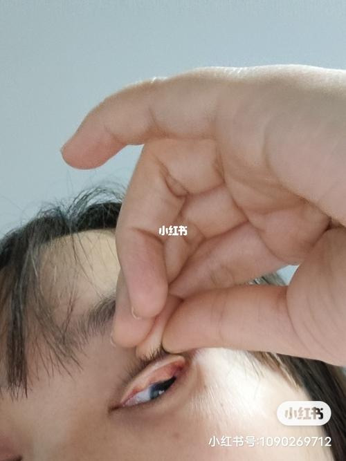 霰粒肿十几年_按摩_医疗健康_医疗健康其他