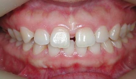 牙齿矫正也能达到整形效果