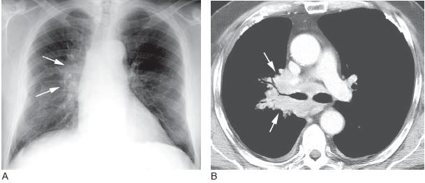 肺癌的影像学表现【下】(多图)