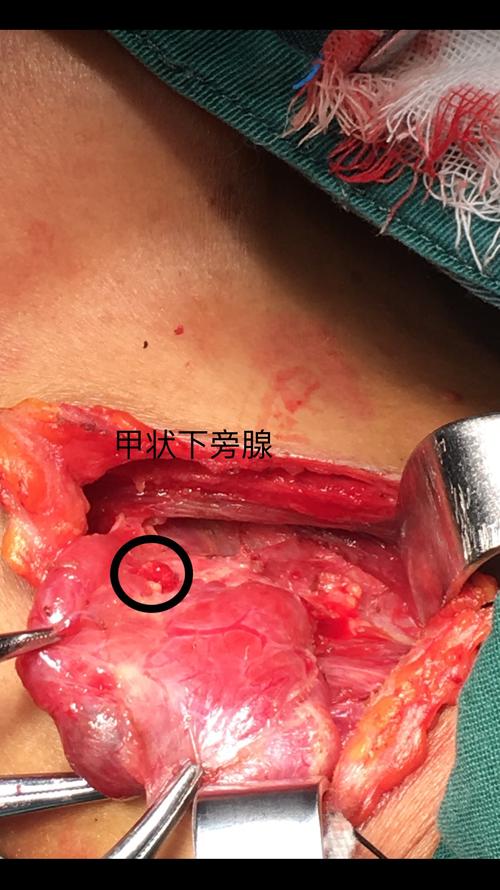 宣化区医院普外科完成的一台甲状腺右叶及肿物 甲状腺左叶切除术
