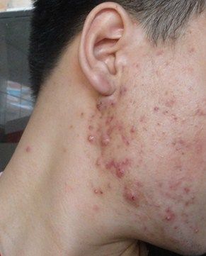 囊肿型痤疮,中医达人请帮帮忙!