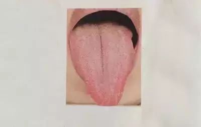 舌诊丨4种舌苔辨清宝宝感冒寒热
