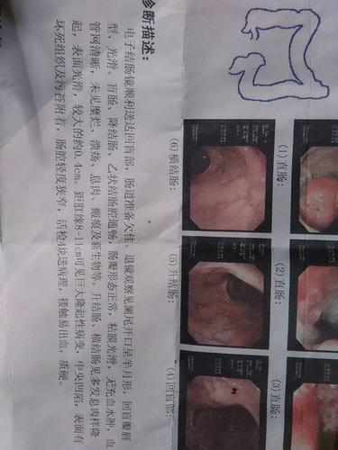 医院检查说患直肠癌!大夫说是重症!实际现在我父亲身体都很正常!