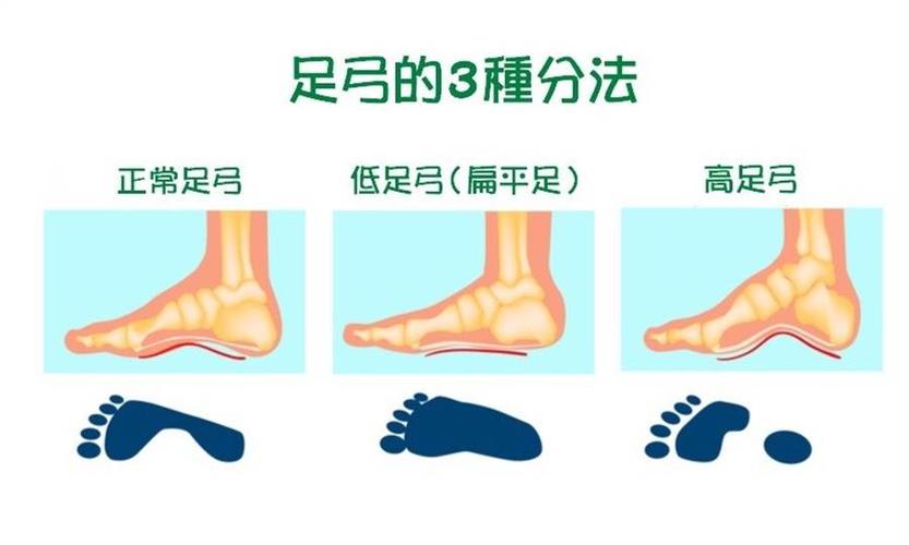 高足弓:指脚踩踏时,足弓与地面的接触悬空,走路跑步时,足弓无法伸展至
