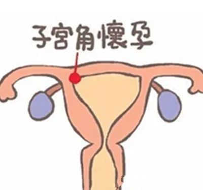 宫角妊娠是什么意思 宫角妊娠是指受精卵在子宫角内着床并生长发育
