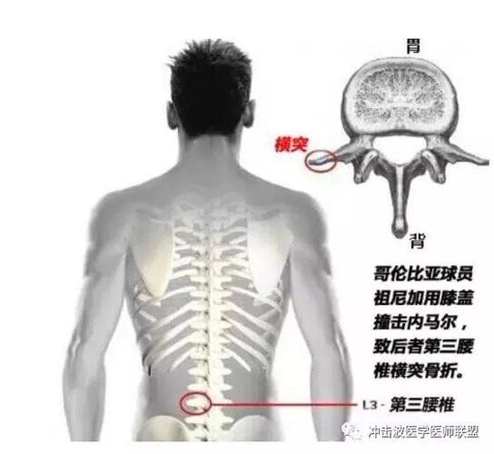 eswt冲击波疗法对第三腰椎横突综合症的治疗