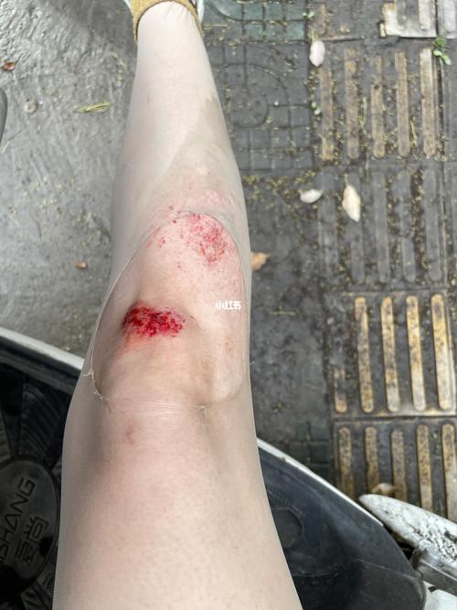 啊啊啊啊啊电动车摔伤真的疼哭了_电动车_运动减肥_药膏_医疗健康