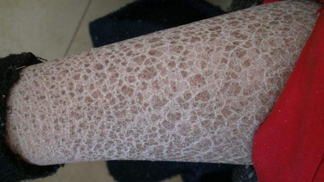 图片来源于网络:患有鱼鳞病的腿 大家老是听说埃及有狮身人面像