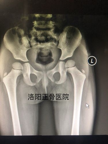 分享一例儿童创伤性髋关节脱位