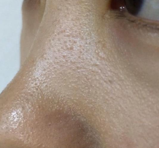 鸡皮肤也叫毛周角化症.