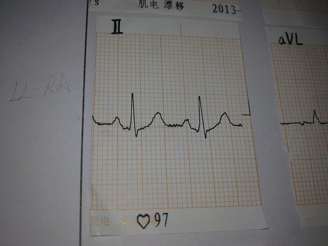 [求心电图高手]这种状况算是j点下移嘛?