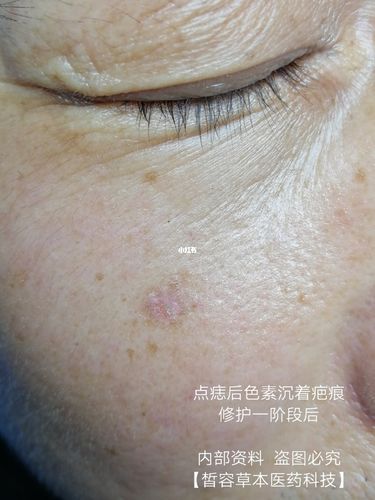 点痣后色素沉着疤痕_疤痕_点痣_祛疤_郑州_代谢_疤痕修复_美妆_医美