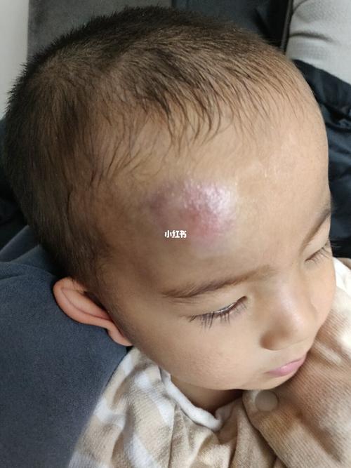 额头又磕了一个大包_紫草油_小朋友_乒乓球_母婴_育儿