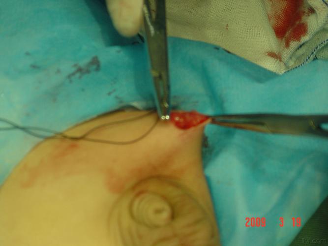 小切口疝囊高位结扎术(组图)