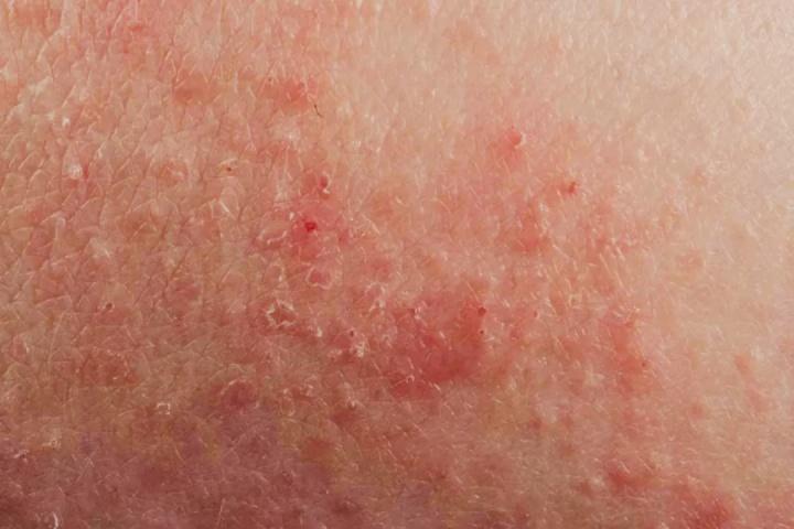 湿疹性皮肤病真的是很常见,占不同人群和族群皮肤科就诊的 10%-30%.