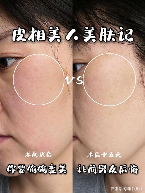 抗衰微针效果图大分享!