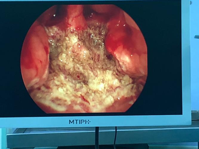 腺样体微创低温等离子射频消融术后