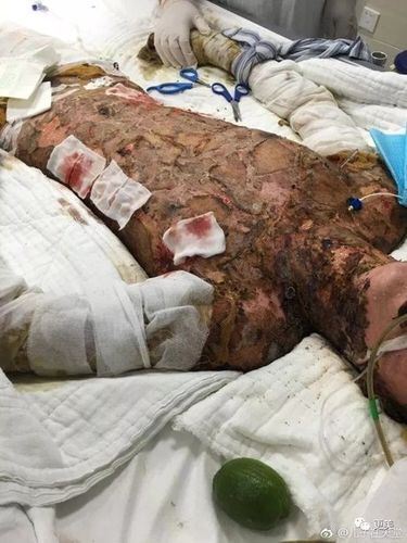 杭州19楼 相关搜索 烧伤患者 重度烧伤 烧伤水泡 中度烧伤 轻度烧伤