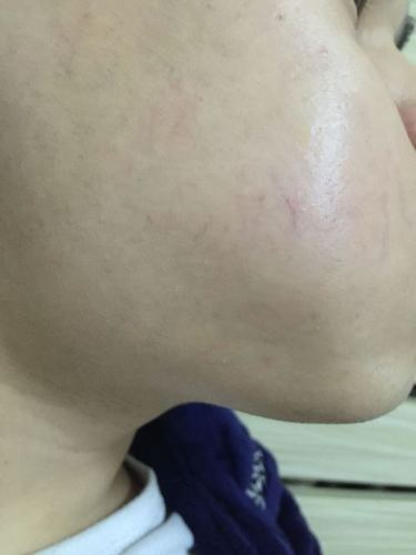脸上有血管,很明显,请问怎么才能消除?