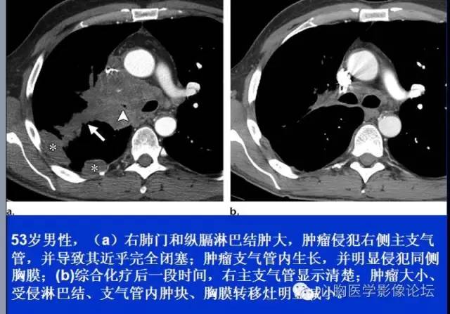 【病例】小细胞肺癌1例ct影像表现