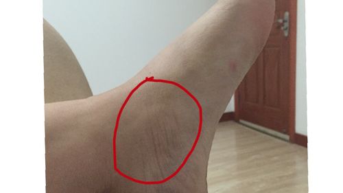 肌腱炎能影响当兵吗能不去吗