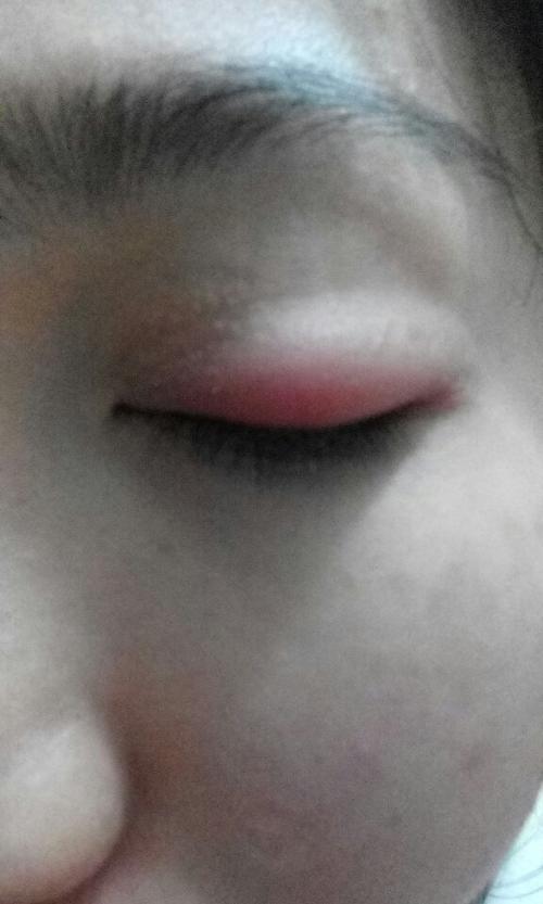 近期时常无故过敏眼睛肿,最明显的是化了眼线后就会肿