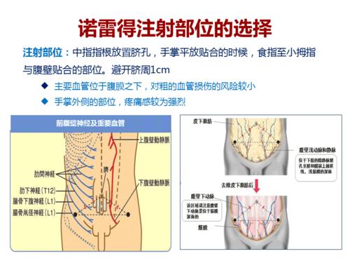 诺雷得的注射