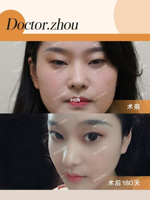 看起来很凶的"吊眼",如何亲和化_内眼角_双眼皮_医美