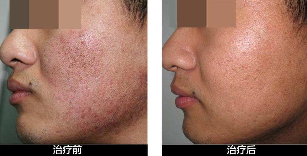 做微针后都有什么注意事项呀?