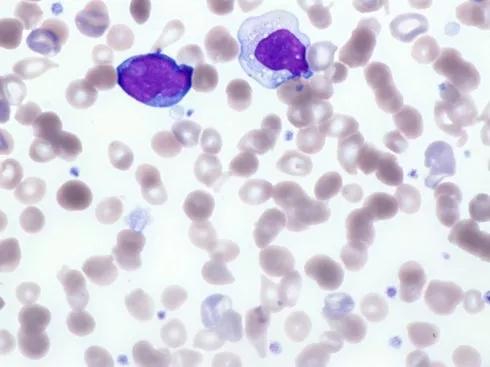 图5:血片镜下图,血小板数量不少,但正常形态的不多 图5显示血涂片