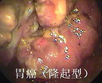 早期胃癌隆起型和凹陷型(图)