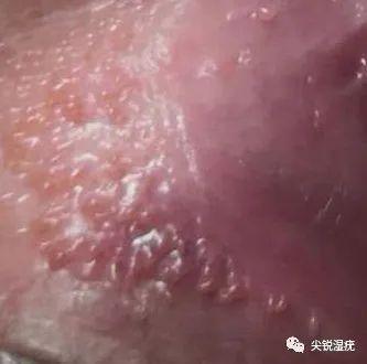 女性假性湿疣与尖锐湿疣辨别图(密集恐惧勿点)