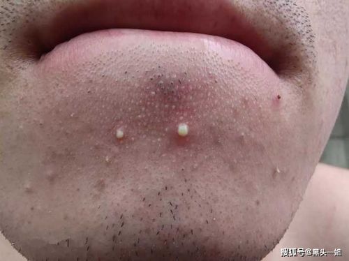 下巴上长的一颗一颗的小白点是什么?有些还能挤出白色
