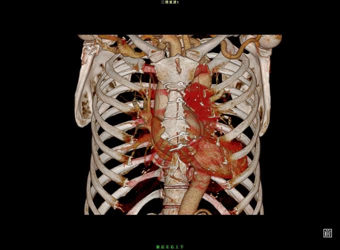 胸骨柄系开胸术后改变.