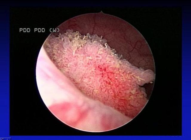 什么是膀胱癌 女性膀胱癌的早期症状