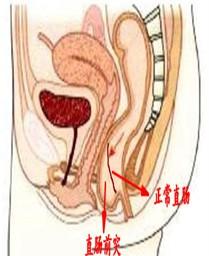 文章列表 医学科普 文章详情     3,直肠前突:直肠前壁突出,患者直肠