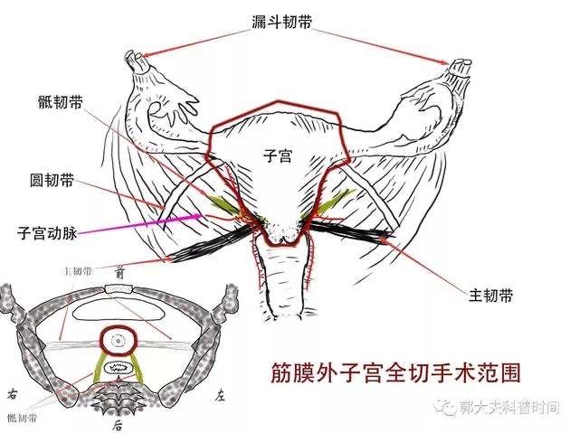 经阴道子宫全切除 阴道前壁修补术 双侧骶棘韧带悬吊术 tvt-0术