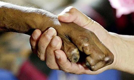 什么是麻风病?麻风病需要做哪些检查?