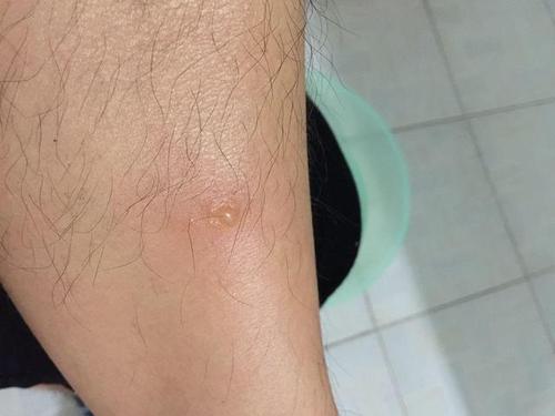 嗜酸性脓疱性毛囊炎的患者,背部面部都会瘙痒,早发现