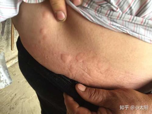 这是不是过敏性荨麻疹?(有照片)?
