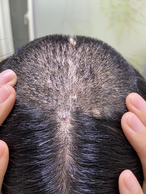 经历了两次毛囊炎,横跨几年,心里负担很重,明明不是什么大毛病