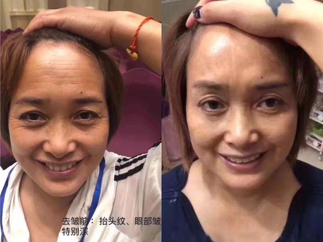 成功案例1:肤色暗沉,皱纹