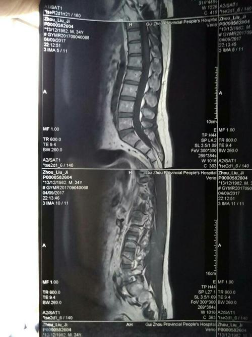 请专家帮我看看腰部核磁共振图,看看有什么问题没?谢谢!